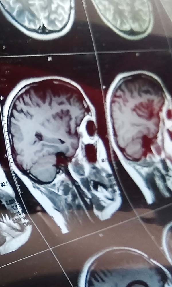 Brain MRI assessment